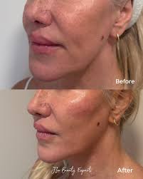 ✨ Subtle Lift, Striking Difference ✨ Through strategic placement of  fillers, we refined the jawline while softening the prejowl area — creating  a smoother, more youthful facial silhouette. Notice how: 💫 Jawline