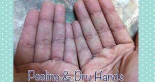Fashion Blog To Give You Outfit Ideas How To Style Dresses And Keep You Updated With Latest Trends I Also Bring Dry Skin Causes Peeling Skin Dry Skin Remedies
