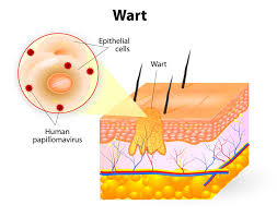 The most common side effect of electrosurgery and curettage is scarring. Wart Treatment Options Have You Tried Everything