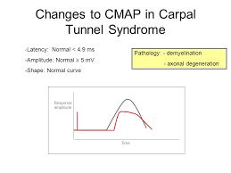Carpal Tunnel Syndrome Nerve Conduction Study Ppt Video Online Download