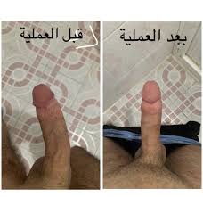 تقوس العضو الذكري ـ اعوجاج القضيب Archives - Mens Health Expert - الخبير  في طب الذكورة و دعامة العضو الذكري و تقوس القضيب