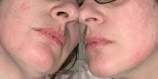 Alimenti che possono indurre una dermatite irritativa da contatto gli alimenti che, più frequentemente, inducono una dic sono: Dermatite Allergica Da Mascherina Da Quali Sostanze E Causata E Come Curarla