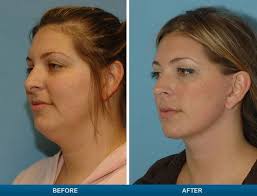 Why Do You Need A Surgery For That Double Chin Simple Check Out This Before And After Picture Http Ww Neck Liposuction Chin Liposuction Double Chin Removal