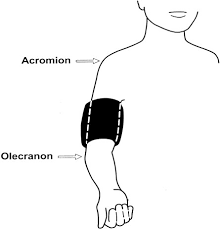 28 a different chapter in the same book recommends that the cuff should cover approximately 75% of the upper arm. Nkf Kdoqi Guidelines