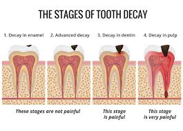 Root fillings, tooth crowns, composite but it's not just what you eat — it's how you eat it. Dealing With Decay St Charles Dental