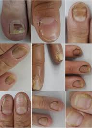Image result for onychomycosis