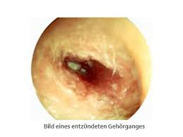 Dadurch reißt die wunde immer wieder auf und der heilungsprozess wird unterbrochen. Gehorgangsentzundung Otitis Externa Hno Biberach Hals Nasen Ohren Arzt In Biberach A D Riss