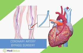 Bypass.open/ must not be called in a setup_all blocks due to the way bypass verifies the expectations at the end of each. How Is Coronary Artery Bypass Surgery Performed Mediglobus