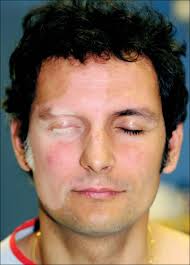 Revised classification/nomenclature of vitiligo and related issues: References In Vitiligo The Lancet