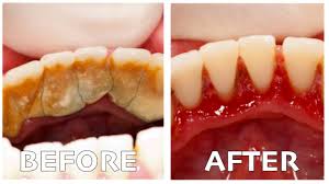 Penyebab Gusi Bengkak Dan Cara Merawat Gusi Agar Tetap Sehat