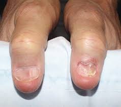 Image result for Koilonychia feet