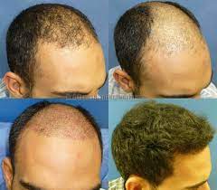 Massage the mixture of oils on the bald spots for about five minutes. Will Hair Regrow On A Bald Forehead By Using Beard Oil Quora
