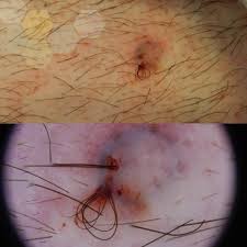 Skin conditions that mimic ingrown hairs. Luminous Skin Cancer And Scar Centre Ingrown Hair Cyst This Cyst Contained More Than 15 Pieces Of Hair Facebook