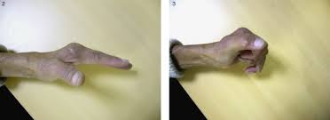 Every day new 3d models from all over the world. Swanson Type Silastic Arthroplasties Of The Pip Joint For Rheumatoid Arthritis Results Of 19 Implants At 5 3 Years Of Follow Up Sciencedirect