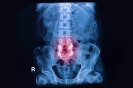 What You Need To Know About Failed Back Surgery Syndrome