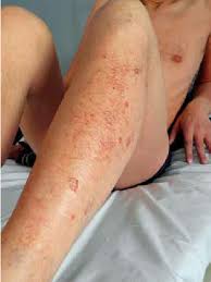 Image result for liver spots on legs