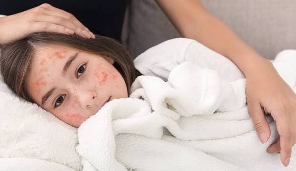 Measles Cases Have More Than Doubled in 2026: Who's Actually at Risk and What to Check Now
