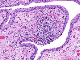 Image result for tonsilla palatina