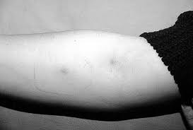 Image result for Pathergy