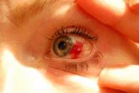 Geplatzte Ader Im Auge