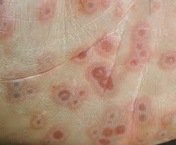 Image result for Erythema Multiforme Causes