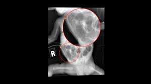 Image result for Necrotizing Enterocolitis