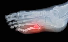 Image result for Toe Fracture