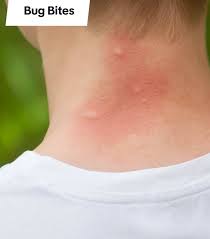 Image result for scabies bite