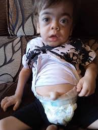 Fundraiser by IBRAHIM ALTAQATQA : Help Save Hamza: A Gaza Child Fighting a  Rare Disease