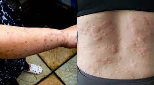 Bed Bugs Vs Hives How To Tell If It S Just A Bite Or An Allergic Reaction