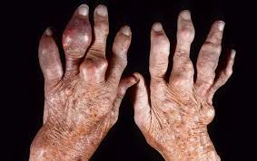 Image result for gout