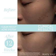 Clear Proof Before And After Pictures Online Discount Shop For Electronics Apparel Toys Books Games Computers Shoes Jewelry Watches Baby Products Sports Outdoors Office Products Bed Bath Furniture Tools