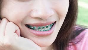 Not appropriate for severe cases; How Long Will I Need To Wear Braces Smile Pad