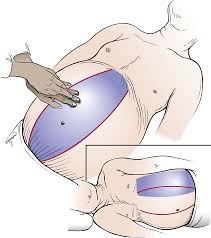 Image result for Shifting Dullness Test