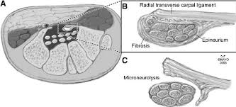 A and B, Operative findings consistently demonstrated adhesion of the...