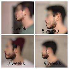 It isn't a reflection of having low testosterone. 9 Weeks Into My Super Patchy Beard Journey It S Been A Tough One Patchy Beard Patchy Beard Styles Patchy
