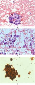 Form of cancer with a poor prognosis, with pleural mesothelioma patients having a . Sudden Cardiac Death Due To Primary Malignant Pericardial Mesothelioma Brief Report And Literature Review Sciencedirect