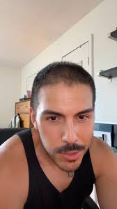 2 months post-hair transplant ✔️ the transplanted hair is still dormant but  should grow in some time next month! #hairtransplant #malepatternbaldness  #balding #hairloss #hairtransformation ...