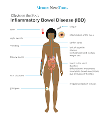 Inflammatory Bowel Disease Causes Symptoms And Treatments