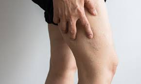 Deep Vein Thrombosis Dvt Risk Factors Pulmonary Embolism