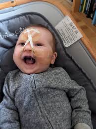 Meet Milo! Milo is the happiest baby bringing joy to all those around him,  especially his mom and dad. Milo was born with a rare craniofacial  condition called Robin sequence which can