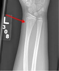 Care guide for wrist fracture in children. Orthokids Forearm Fractures