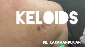 Treatment of inflammatory acne requires multiple steps. How To Get Rid Of Acne Scars On Back And Shoulders Herunterladen