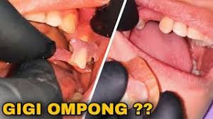 We did not find results for: Pemasangan Gigi Palsu Valplast Dokter Gigi Tri Putra Youtube