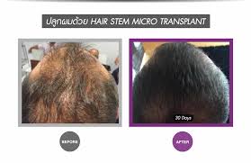 So the thinking goes that replenishing dp cells in people experiencing hair loss could help kickstart regrowth. Breakthrough Stem Cell Treatment For Hair Loss Apex Profound Beauty