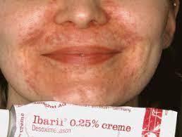 Steroid Rosacea Dermnet Nz