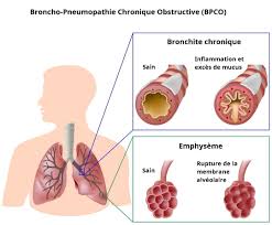8) green m., michaels m.g. Bpco Cause Complications Traitement Quelle Esperance De Vie