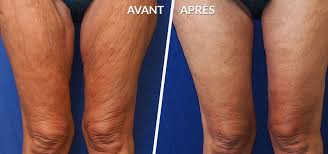 Le lifting des bras est une chirurgie esthétique des bras ou une chirurgie réparatrice des bras. Dermolipectomie Des Bras Cuisses Dr Charambros Georgiou Bastia