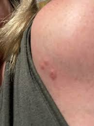 Image result for bedbug bites look like