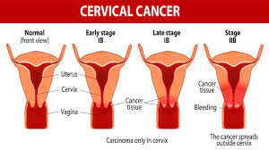 The majority of patients come to the doctor because of abnormal vaginal episodes of bleeding (after sex, in between regular periods, after the menopause etc.) or just a persistent vaginal discharge which is watery or blood tinged. Cervical Cancer Symptoms Causes Treatment Medicine Prevention Diagnosis Rajasthan Medical Center Tohana